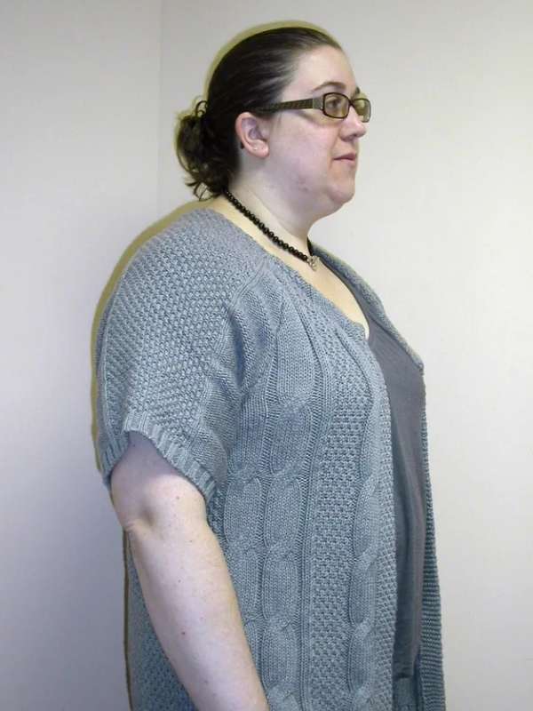 Amy’s Success Story at The Institute for Weight Management & Wellness in Hackensack, NJ Amy’s Success Story at The Institute for Weight Management & Wellness in Hackensack, NJ