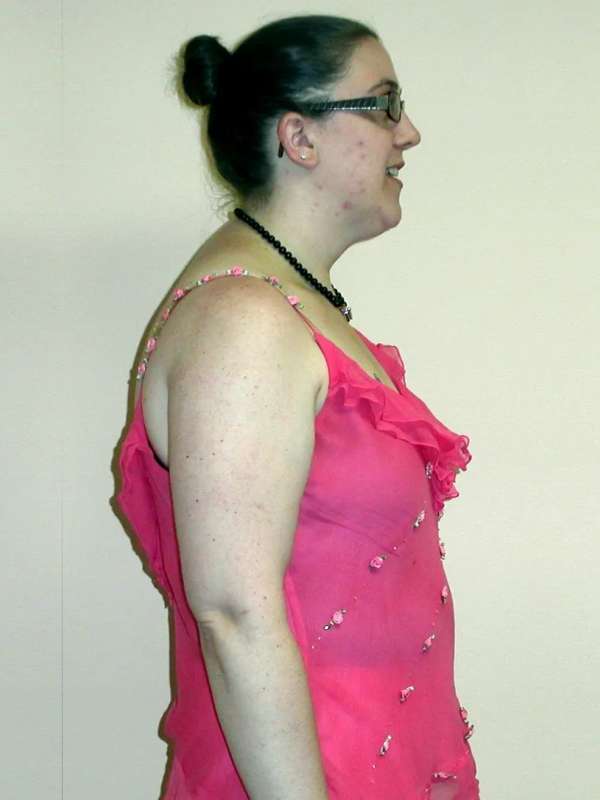 Amy’s Success Story at The Institute for Weight Management & Wellness in Hackensack, NJ Amy’s Success Story at The Institute for Weight Management & Wellness in Hackensack, NJ